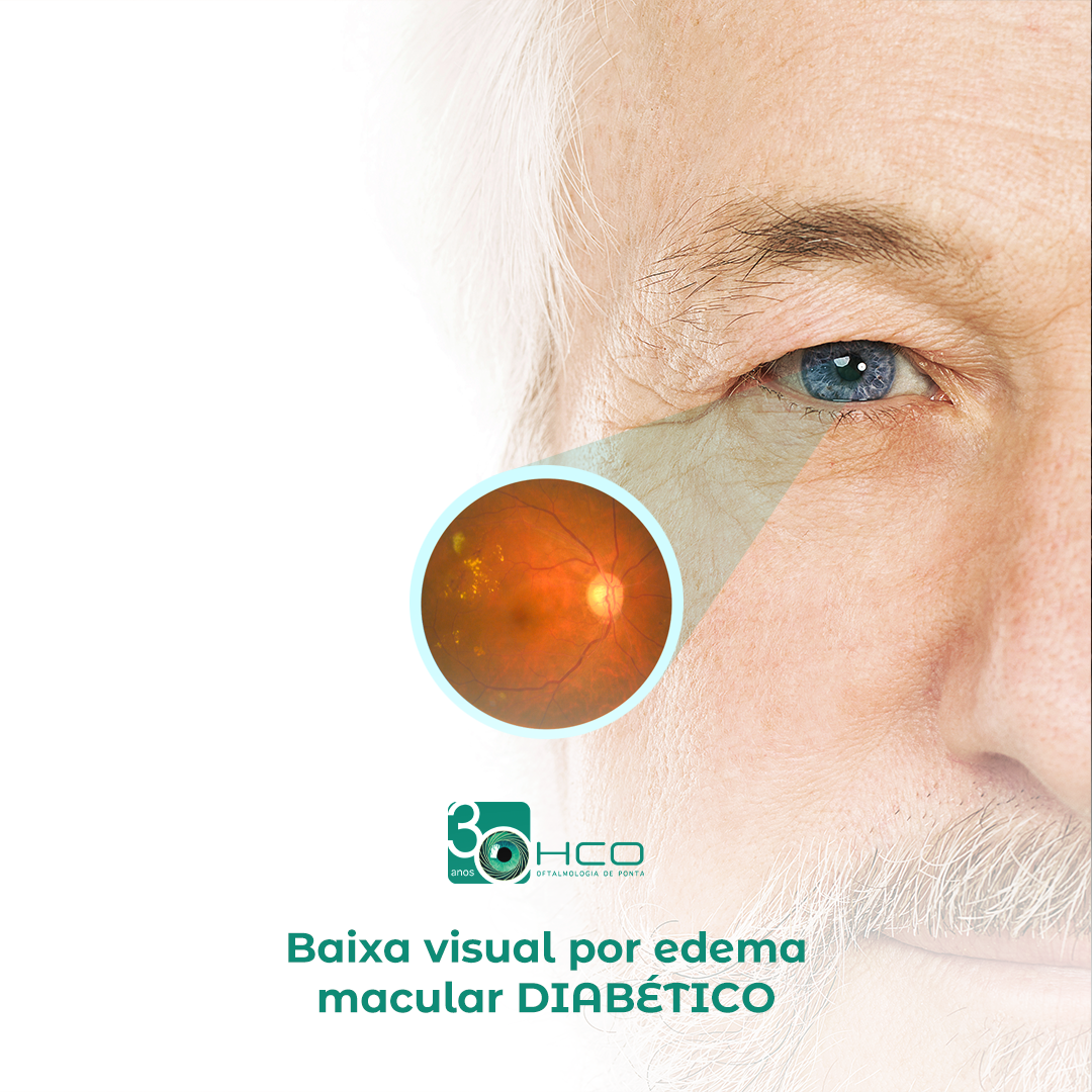 Baixa visual por edema macular diabético