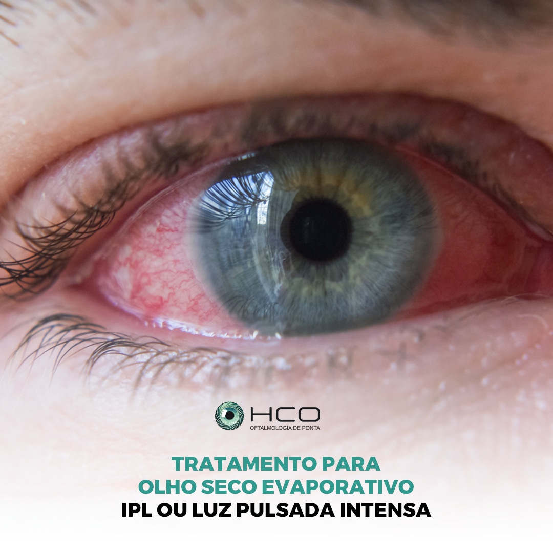 Tratamento para olho seco evaporativo - IPL ou luz pulsada intensa - parte 2