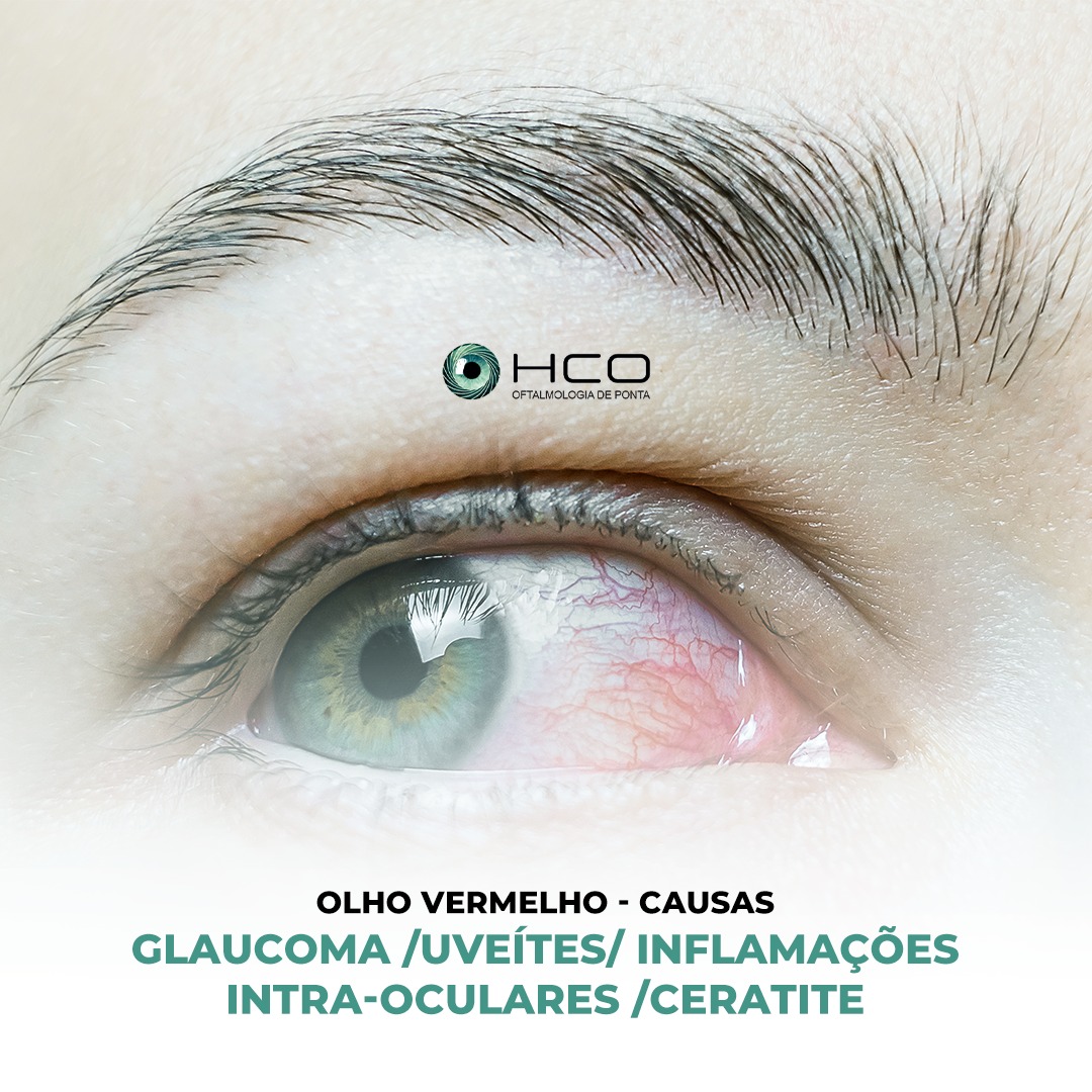 OLHO VERMELHO - Outras causas: - Glaucoma -Uveíte/ inflamações intra-oculares -Ceratite