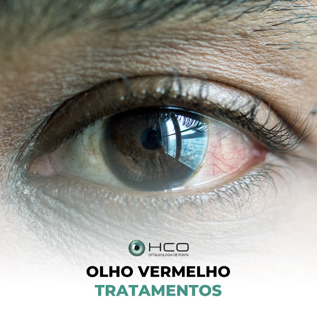 OLHOs VERMELHOs - tratamentos