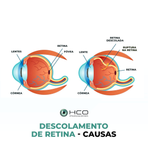 Deslocamento de retina - Causas