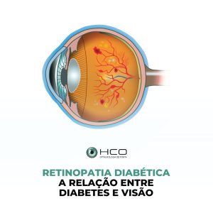 Retinopatia Diabética: A relação entre Diabetes e Visão