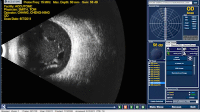 hco-ultrasson-b-scan-plus-accutome-v1 hco-ultrasson-b-scan-plus-accutome-v1